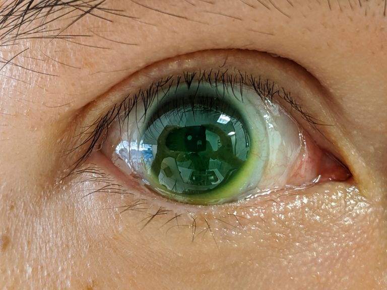 Scleral Lenses in Dallas, TX Plaza Vision Center