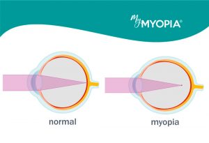 explaining myopia